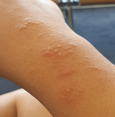 여행중 겪은 햇빛 알레르기 증상과 대처방법